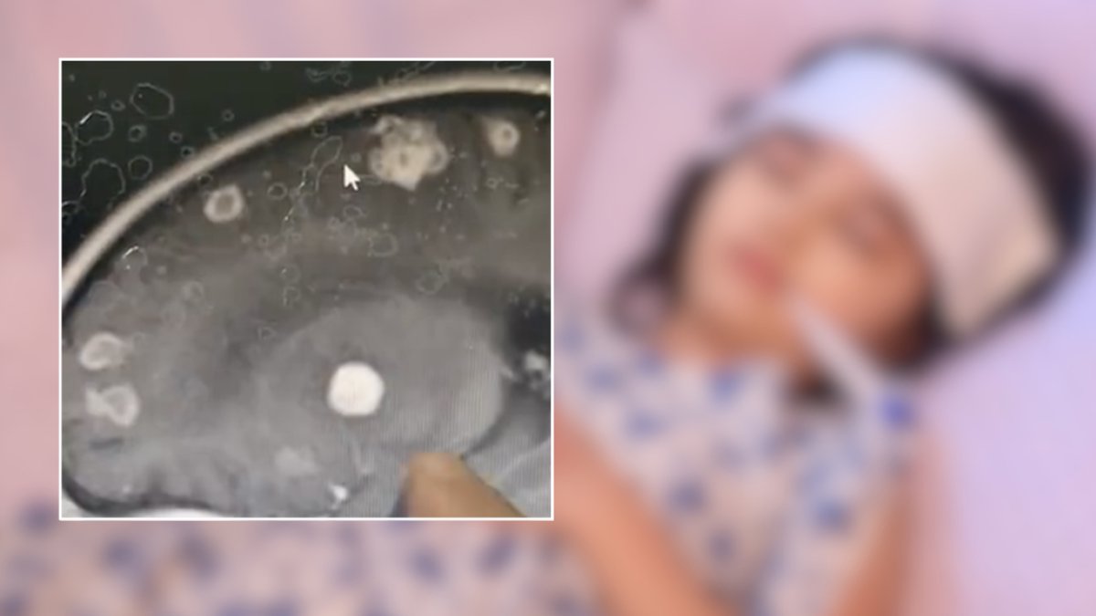 開冷氣前大掃除吸入奪命真菌!女童高燒17日腦穿20洞 醫生揭高危黑點