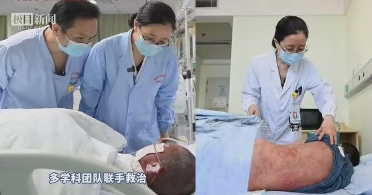武漢10歲男童全身逾8成皮膚剝落