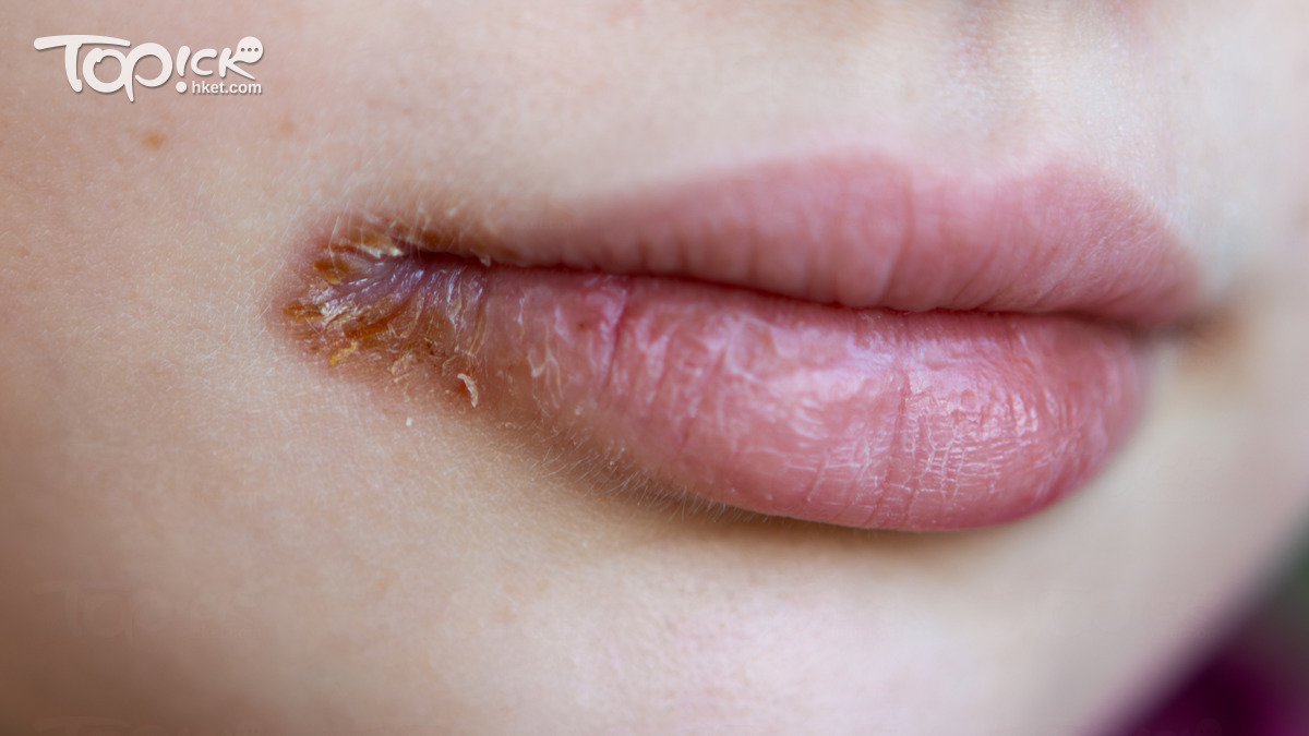 皰疹病毒 30歲女爛嘴角以為熱氣
