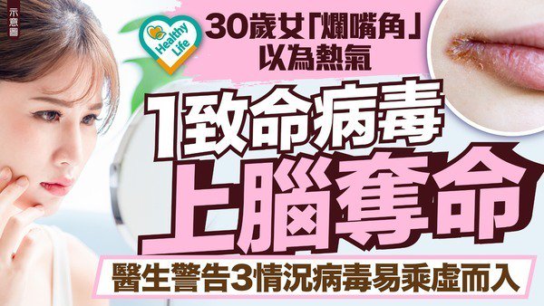 皰疹病毒 30歲女爛嘴角以為熱氣